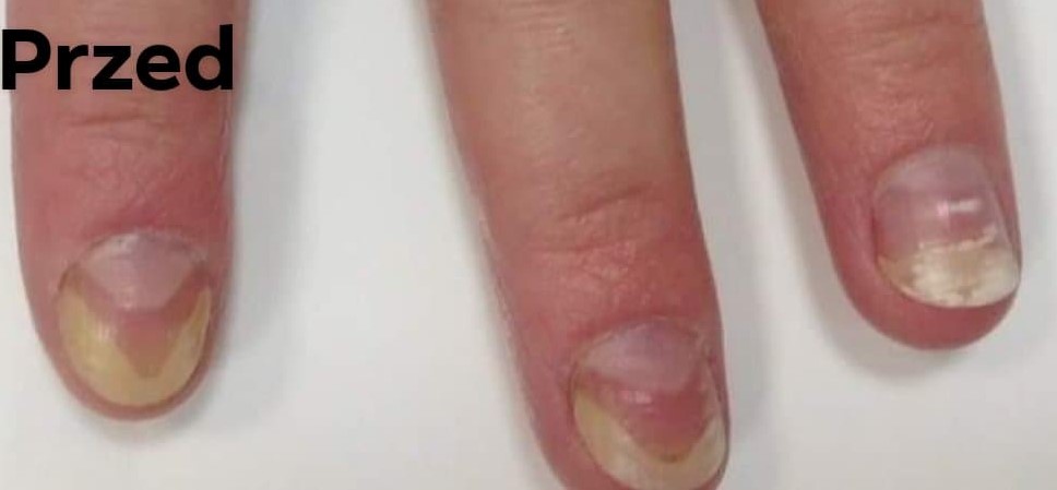 grzybica paznokcia rece przed 1