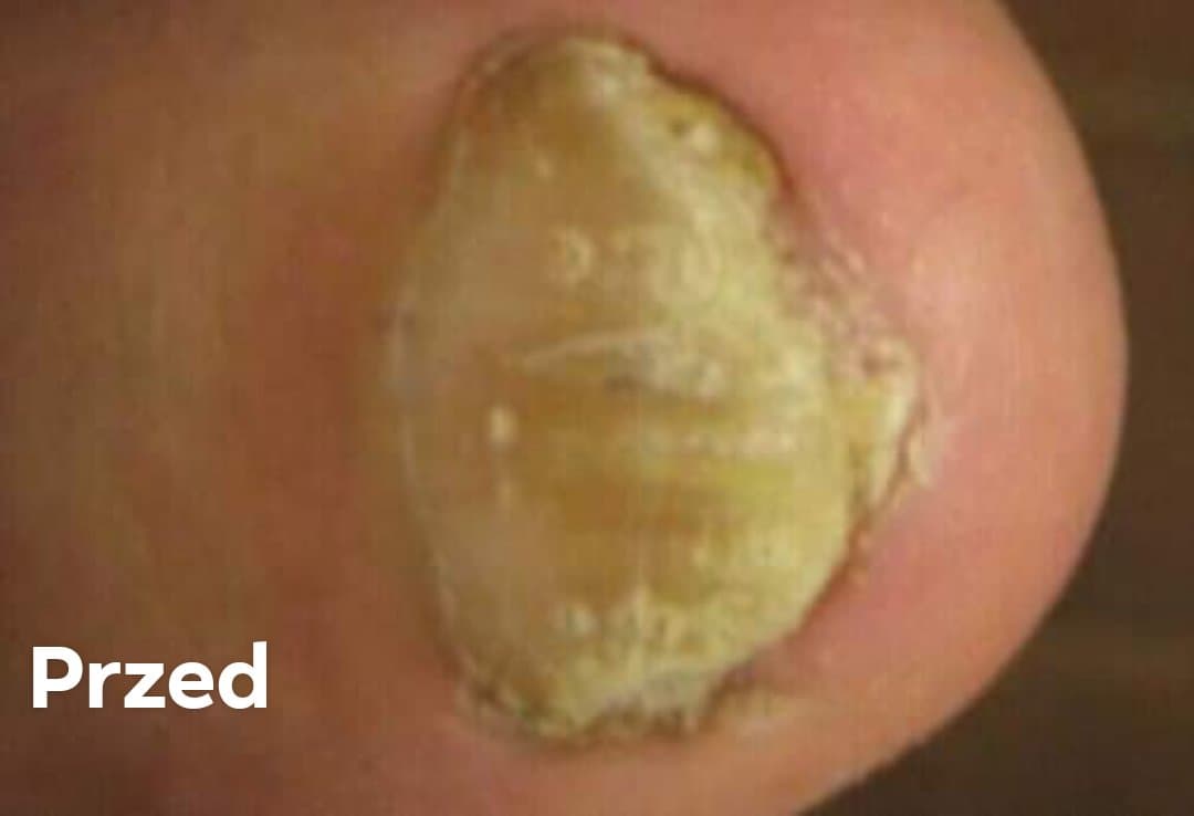 grzybica paznokcia stopa przed