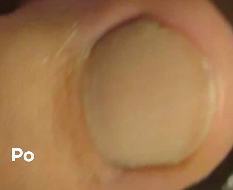 grzybica paznokcia stóp po 1