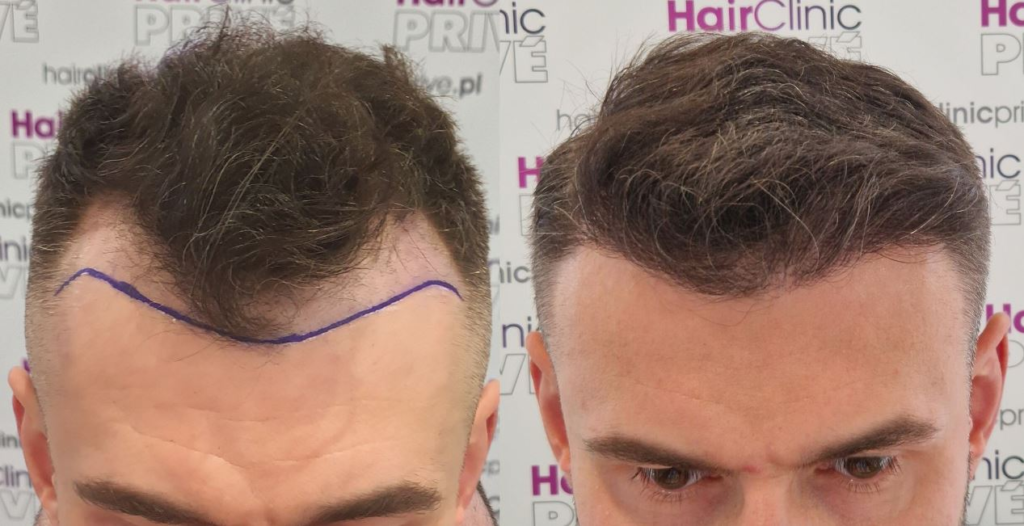 PRZESZCZEP WLOSOW DHI 1024x526