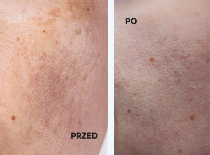 krem clarena na noc przebarwienia przed copy