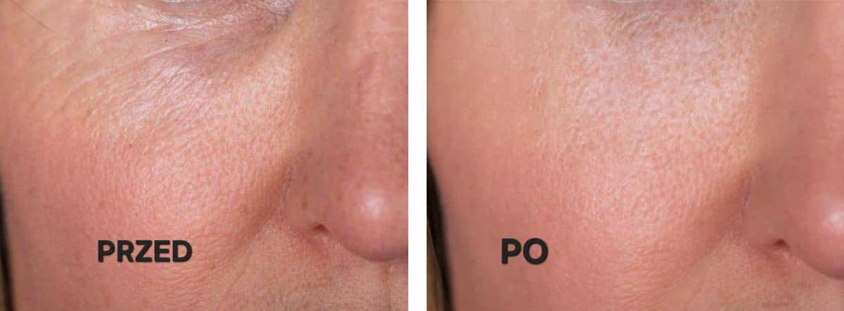 musse oil mask przed i po