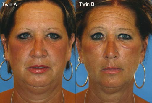 Fot. 1 Porównanie procesu starzenia skóry u bliźniaczek. Źródło: [I]