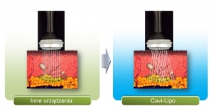 Nieinwazyjna redukcja tkanki tłuszczowej i cellulitu – możliwości i zagrożenia.