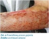 I - Przeszczepy skóry jako metoda leczenia ran oparzeniowych