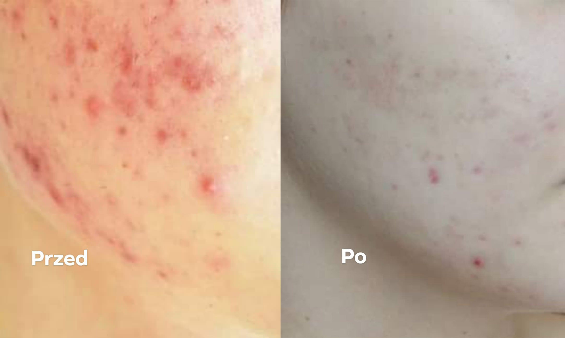 trądzik kuracja nanosrebro przed i po