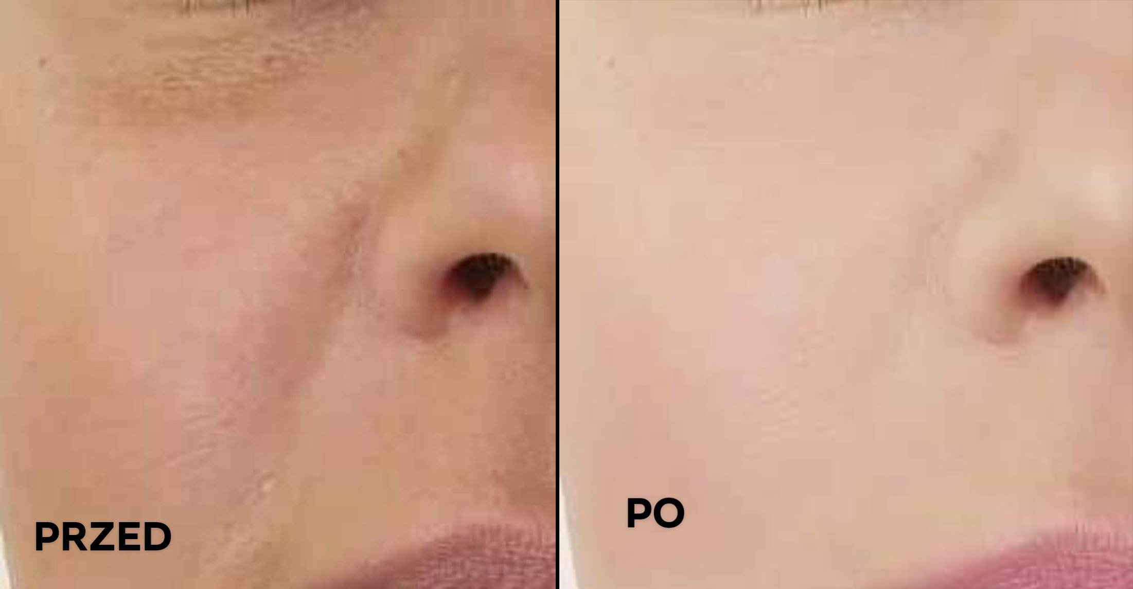 lynia zestaw1 zdjęcie przed i po