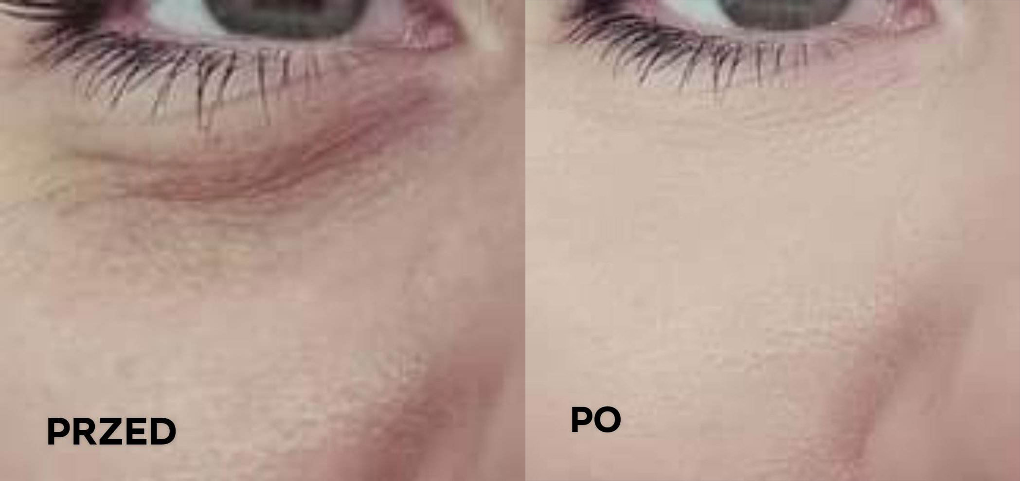 zdjecie przed i po worki pod oczami