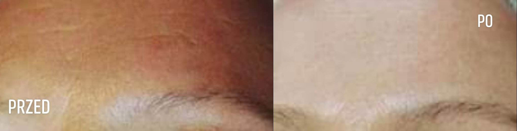 LYNIA ZESTAW 7 PRZED i PO