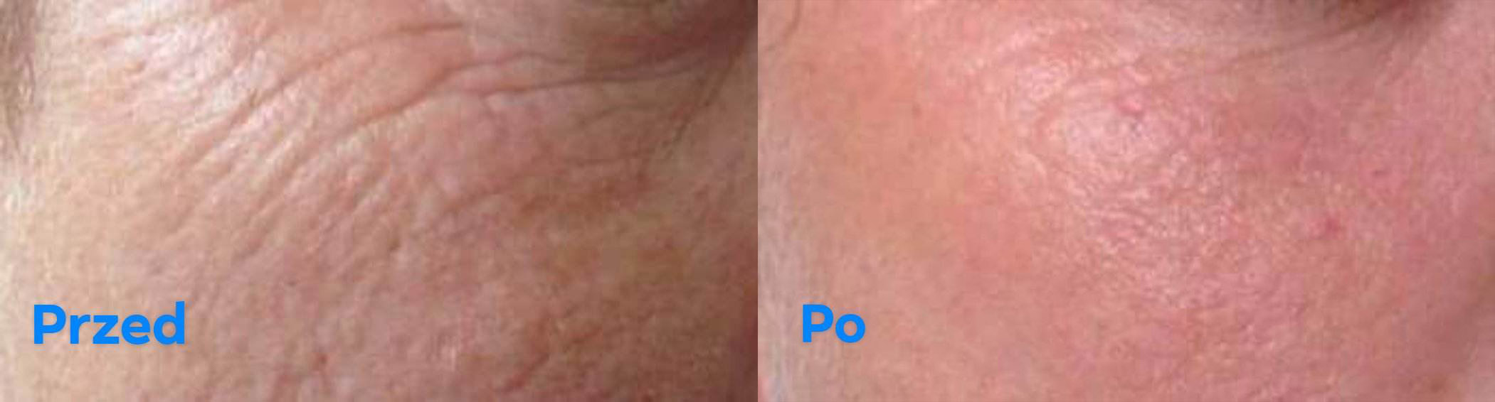 zdjęcie przed i po lynia zestaw 60+