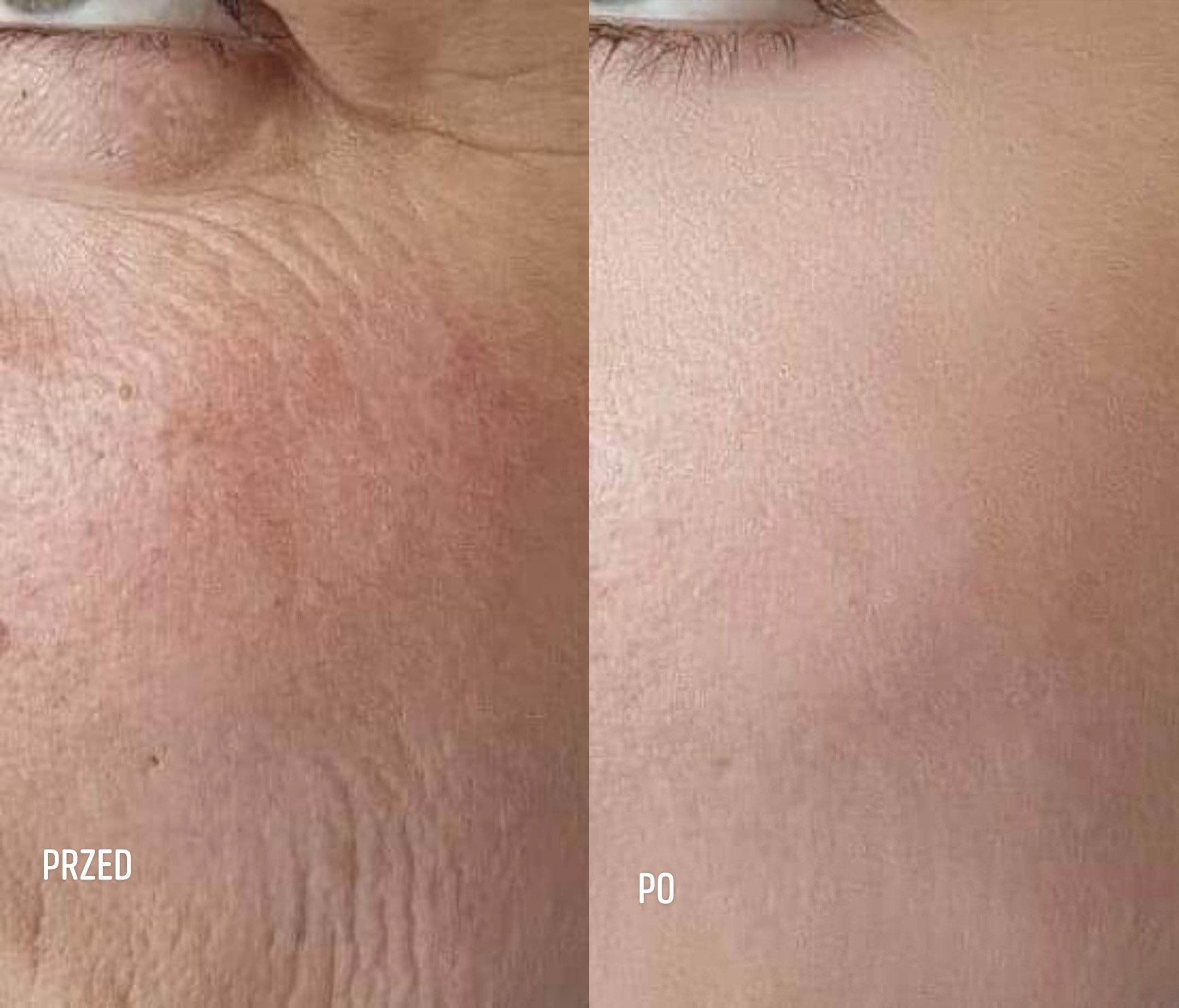 zdjęcie twarzy przed i po kolagen activ gel nr.3