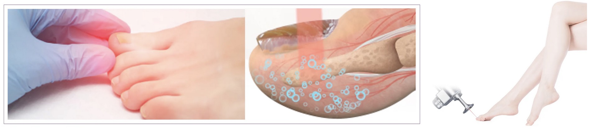 Jak laser frakcyjny CO2 leczy grzybicę