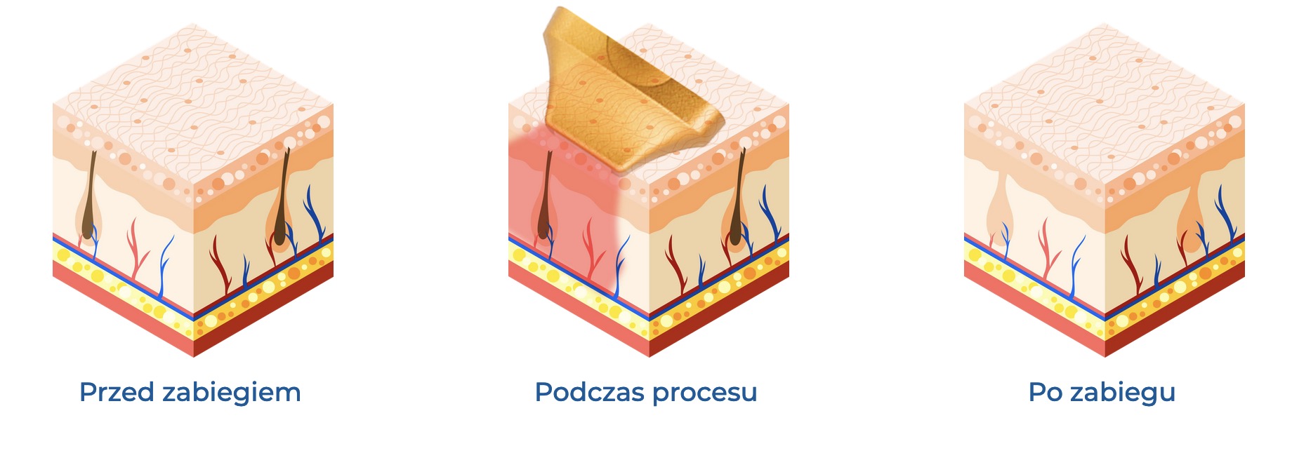 Jak przebiega zabieg depilacji urządzeniem ATTOS