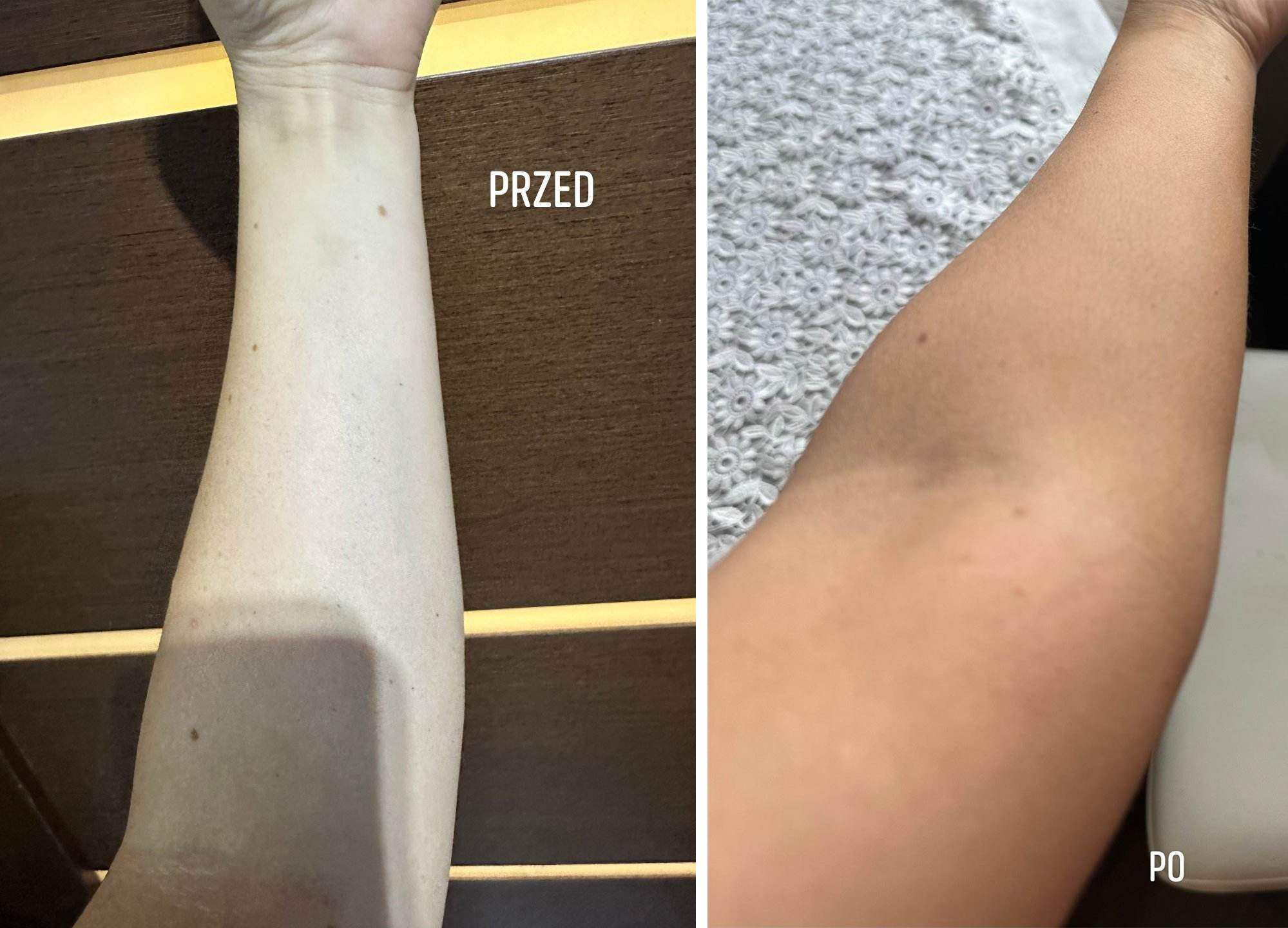 bernadeta przed i po ręka
