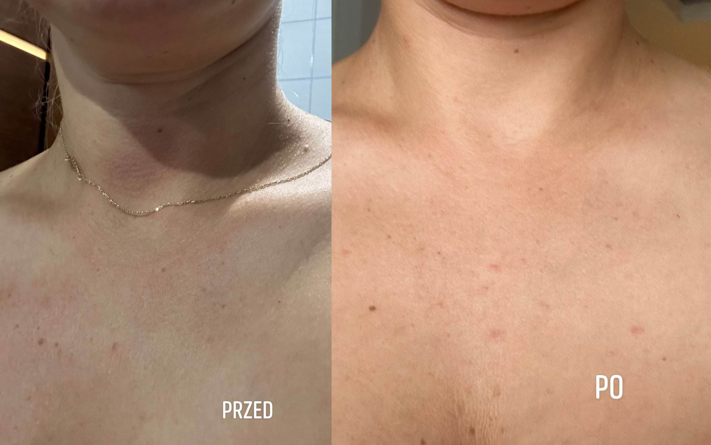 bernadetta przed i po dekolt