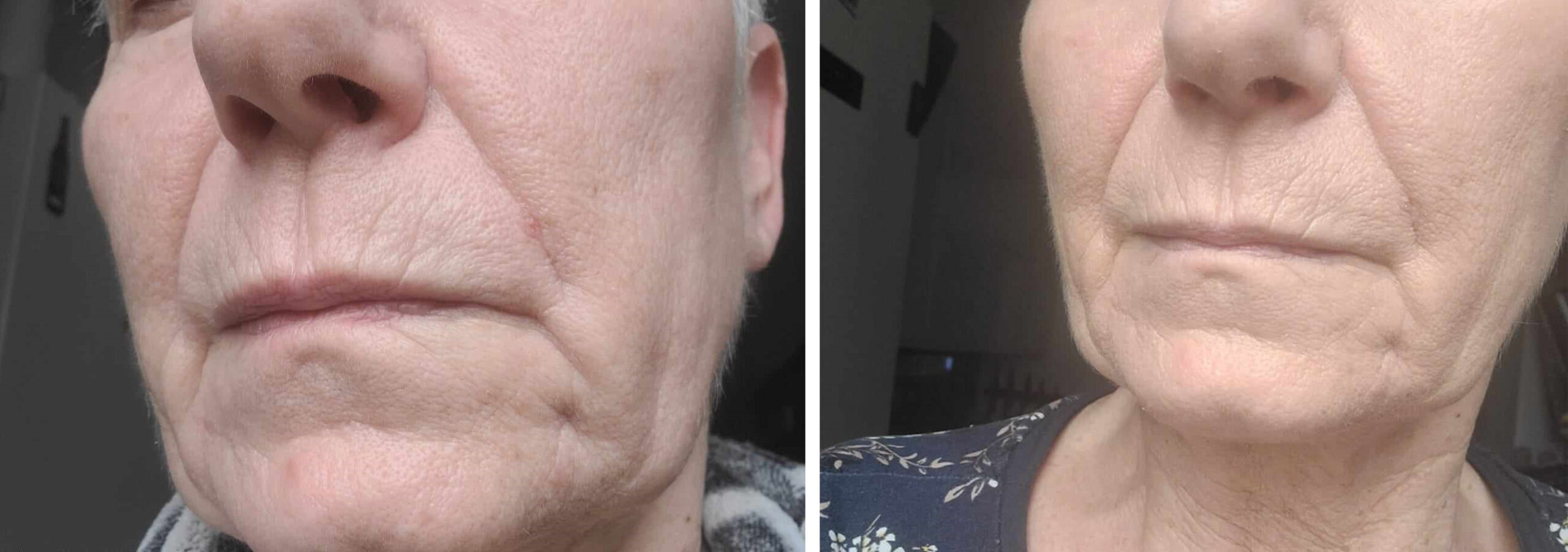 ZOZU PRZED i PO testerka nr 2