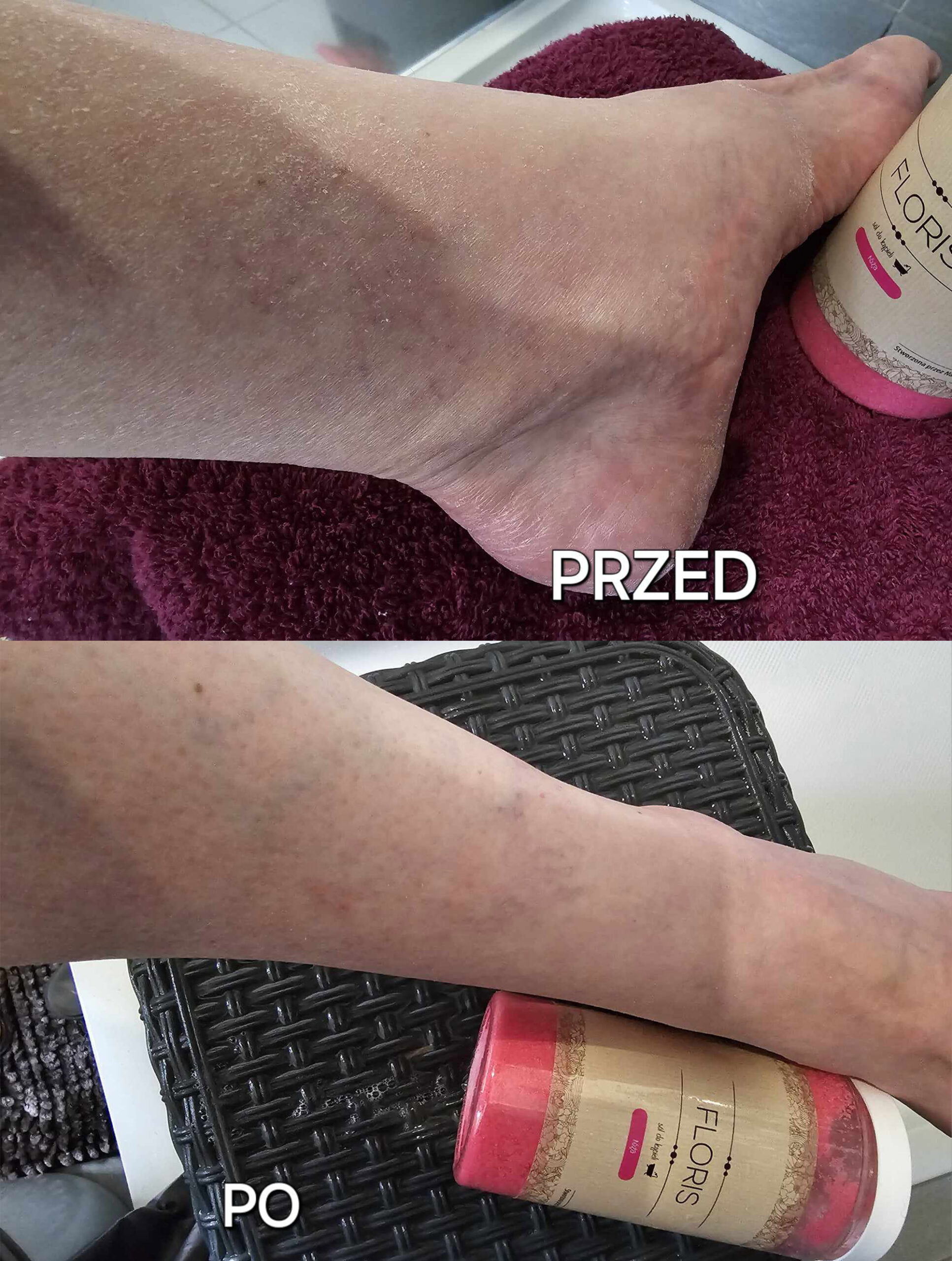 sól floris przed i po 2